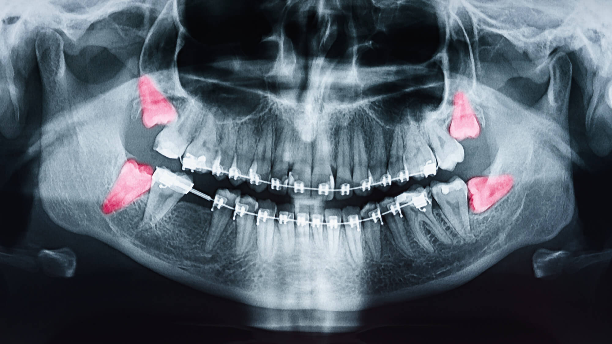 What S Another Term For Wisdom Tooth