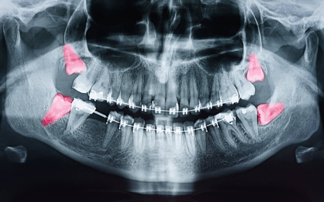 Need Wisdom Teeth Removal in Provo? Here’s What to Expect