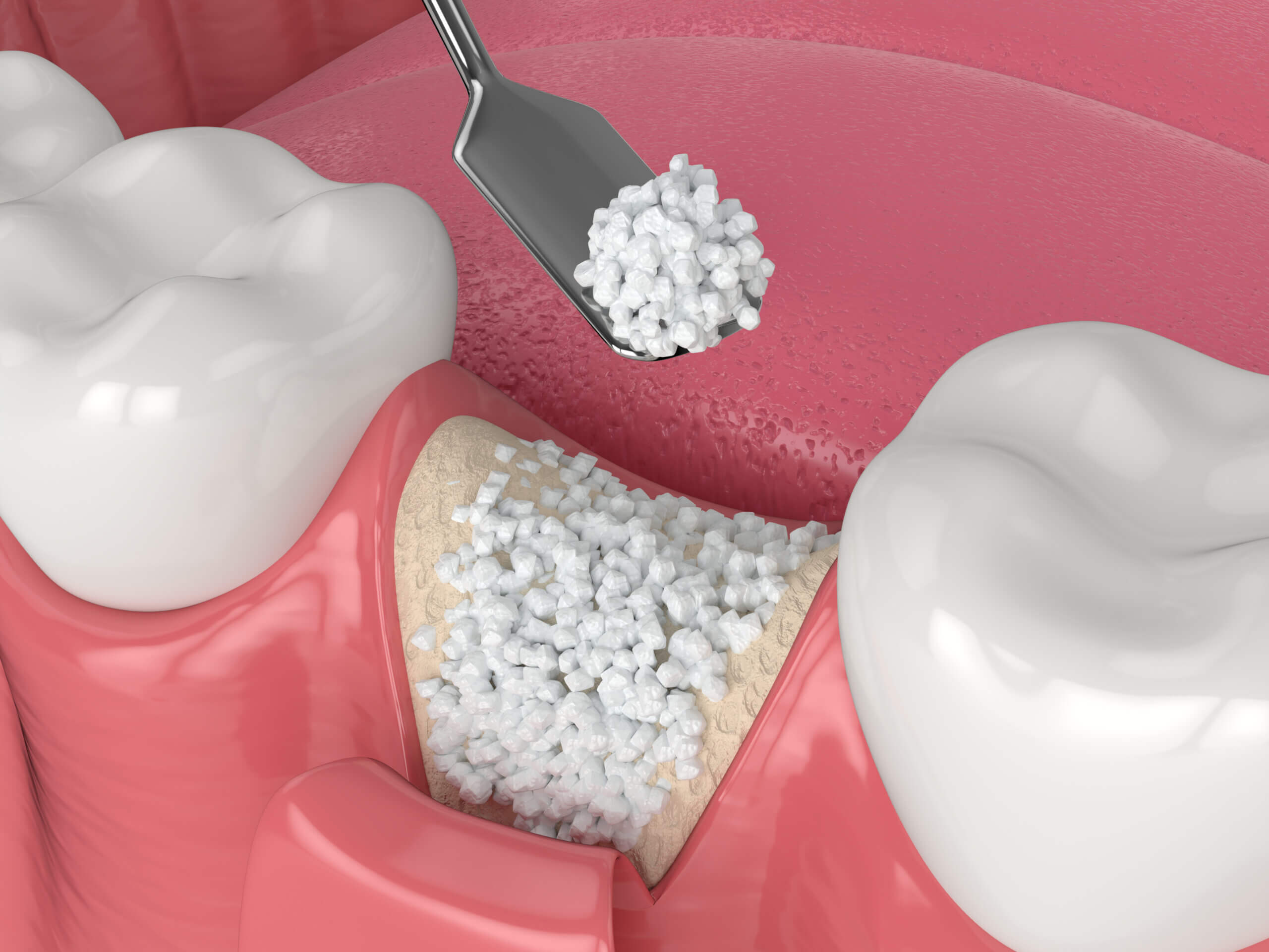 The Importance of Bone Grafting A Service Spotlight Utah Oral Surgeons